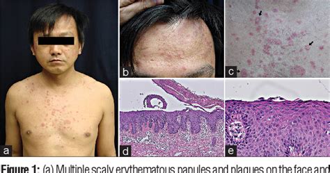 Figure 2 From Pityriasis Rubra Pilaris With Acantholysis Mimicking