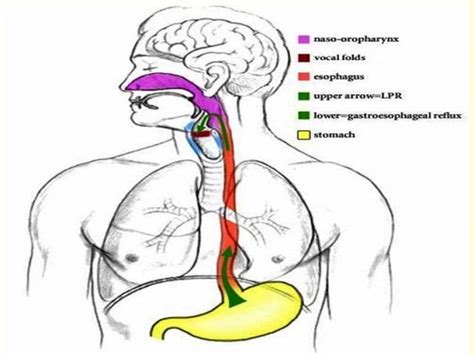 Laryngo Pharyngeal Reflux Lpr