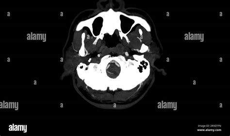 Cta Brain Or Ct Angiography Of The Brain Axial Mip View Showing