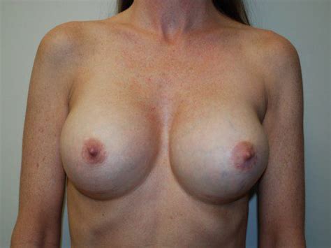 Breast Revision 01 Before After Gallery Allen Doezie MD FACS