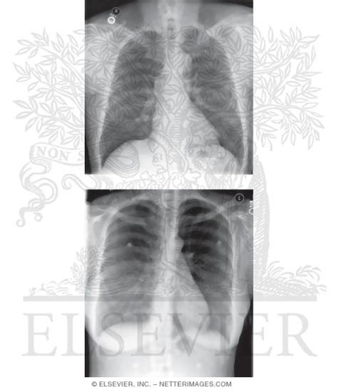 Posterior Anterior (PA) Chest X-Ray (Male and Female)