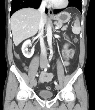 Splenic Infarct Image Radiopaedia Org