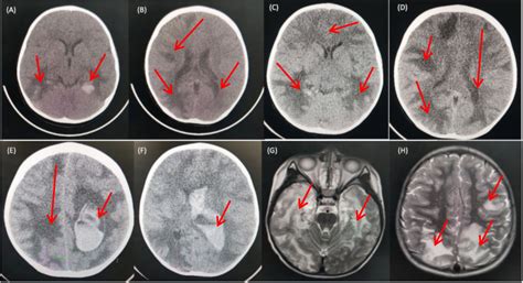 Frontiers Case Report Non Ebv Associated Cerebral Vasculitis And