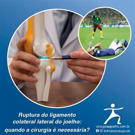 Ruptura Do Ligamento Colateral Lateral Do Joelho Quando A Cirurgia