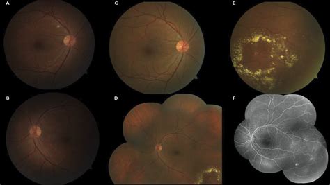 SciELO Brasil Retinal Arterial Macroaneurysms In Patients Recovered