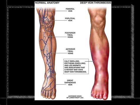 Thrombophlebitis And Dvt Ppt Ppt