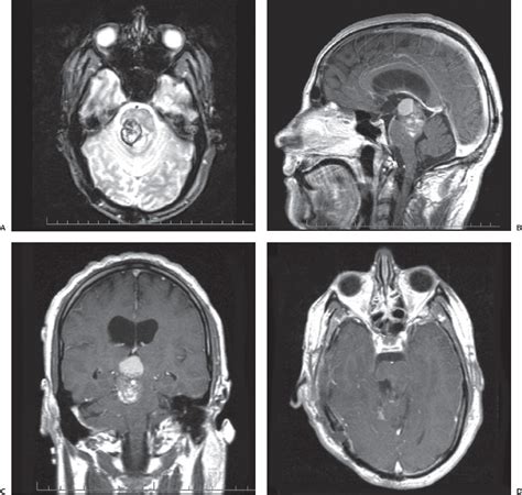 Posterior Fossa Arteriovenous Malformations And Cavernous Angiomas Neupsy Key