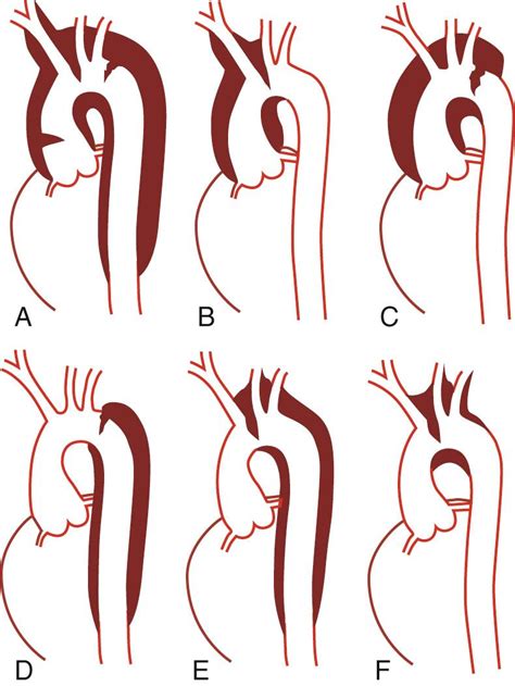 Type A Aortic Dissection Clinical Tree