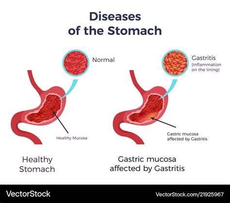 Gastritis Stomach Set Royalty Free Vector Image