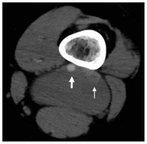 Popliteal Vein Aneurysm Presenting As Recurrent Pulmonary Embolism