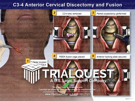 C Anterior Cervical Discectomy And Fusion Trial Exhibits Inc