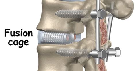 Lumbar Fusion With Cage And Pedicle Screws Spondylolistisis Grade 3