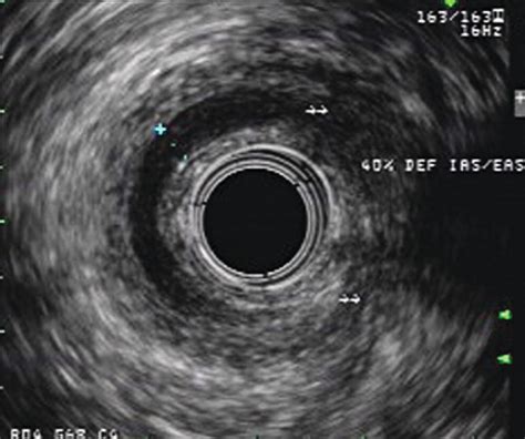 Anal Sphincter Disease Radiology Key