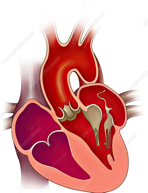 Mitral Valve Chorda Tendinea Rupture Illustration Stock Image C