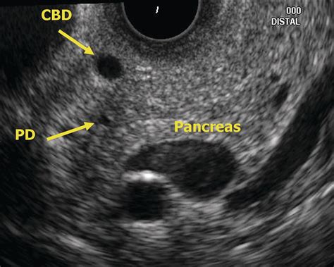 Eus Of The Normal Pancreas Radiology Key