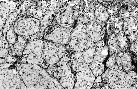 Pathology Outlines Oncocytic Hürthle Cell Tumors