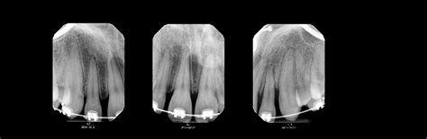 Hello Is This Periapical Radiolucency Im In Need Of A Second Opinion