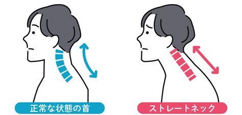 ストレートネック すとれーとねっく とは？交通事故の弁護士無料相談はプロテクトスタンス