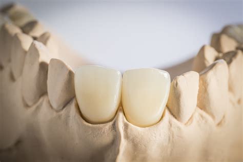 Ips Emax® Ceramic Crowns For A Natural Looking Restoration Precision