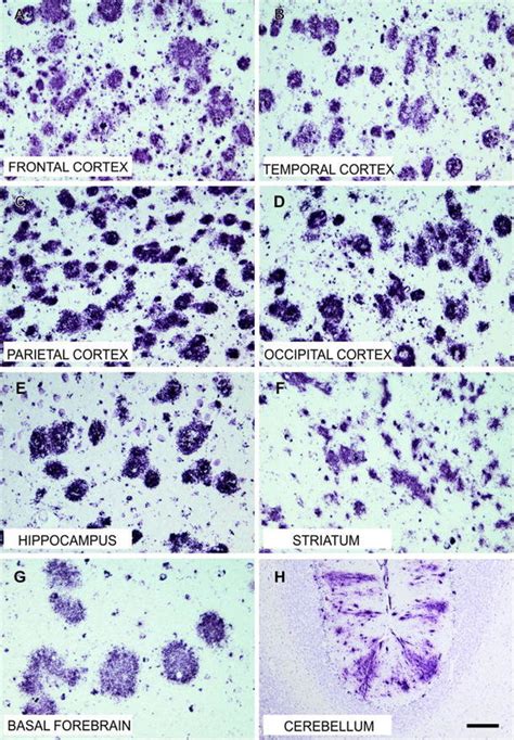 Distribution Aβ pathology Dense and diffuse plaques are distributed in