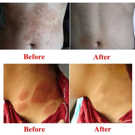 Pityriasis Alba Kind Difference Between Pityriasis Versicolor And