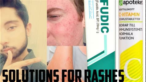 Fusidic Acid Cream Review It S Uses Side Effects Vitamin C For Skin How To Reduce Skin Rashes