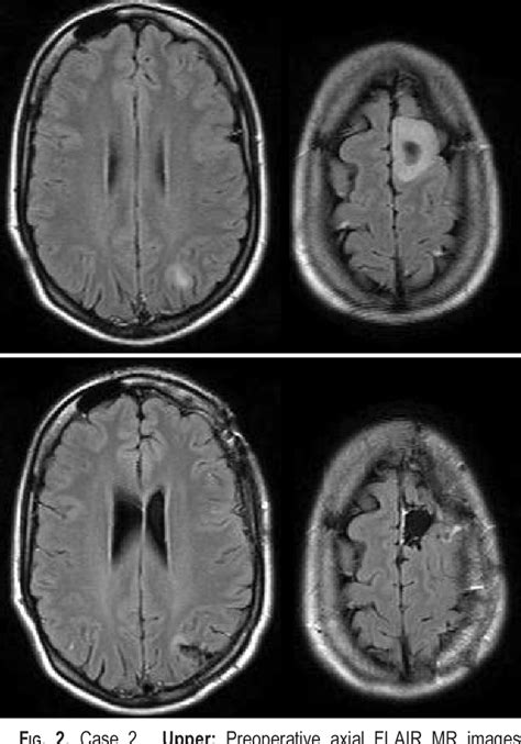 Figure 2 From Surgical Management Of Multicentric Diffuse Low Grade