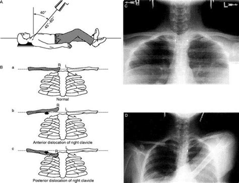 Sternoclavicular Dislocation Trauma Orthobullets