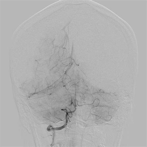 Filecavernoma Dva And Right Ica Aneurysm Radiopaedia 33890 35074