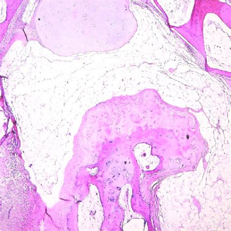 Histopathological Features Of Osteochondrolipoma Showing Mature Adipose