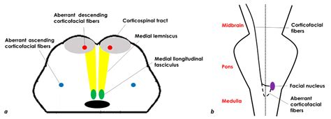 Brainstem Midline Stroke Encyclopedia Mdpi