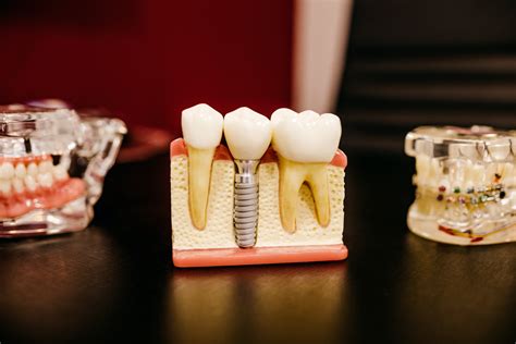 Dental Implants In Forest Lake Mn What Age For Dental Implants