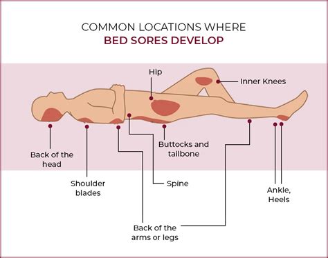 Bed Sore Management