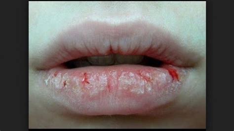 Jangan Dianggap Remeh Ini Tanda Penyakit Jika Bibir Kering And Pecah