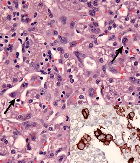 Histiocytic Sarcoma Complex - Distinctive Syndromes | Histiocytosis / School of Veterinary Medicine