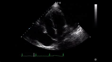 Ecocardiograma Taponamiento Cardiaco Youtube