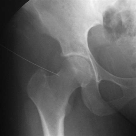 Right Hip With Anterior To Superior Fluoroscopic View Showing The