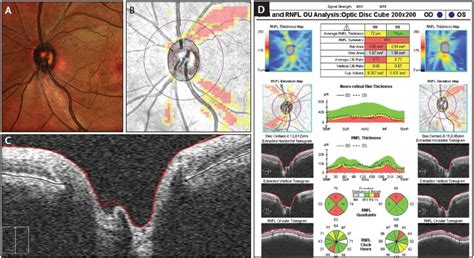 Evaluating the Optic Nerve for Glaucomatous Damage With OCT - Glaucoma ...