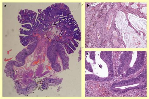 Polyp Pt1 Colorectal Cancer Diagnostic Histopathology