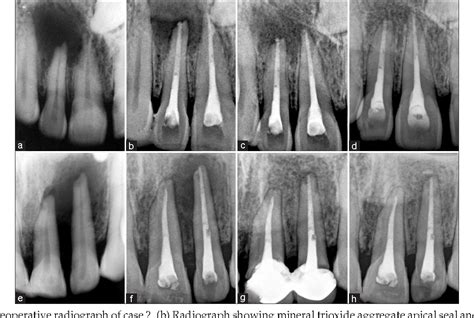 Figure 2 From Nonsurgical Endodontic Treatment Of Teeth Associated With