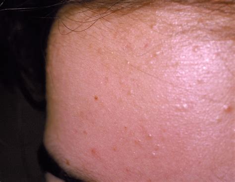 Acne Vulgaris Icd L Online Consultation Ai Dermatologist