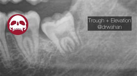 Buccal Trough And Elevation Of Wisdom Tooth Partial Bony Impaction Youtube