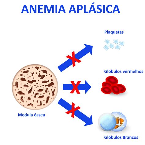 Tratamentos para anemia aplásica como funcionam Revista Online ABRALE