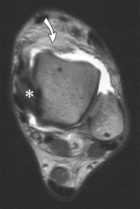 Anteromedial Impingement Of The Ankle Using Mr Arthrography To Assess