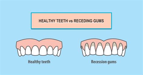 5 Main Causes Of Receding Gums | Gum Recession | Suburban Essex