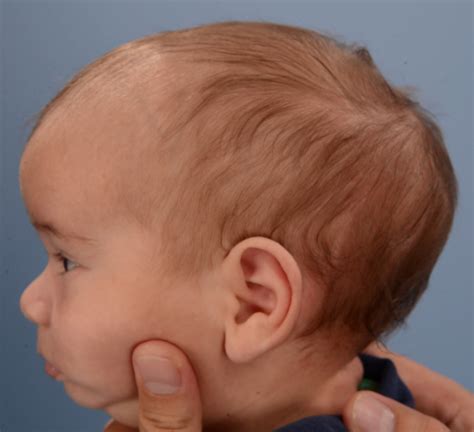 List 100 Pictures Abnormal Baby Head Shape Pictures Updated