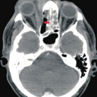 Orbital CT scan showing right sided proptosis as well as micro-erosions... | Download Scientific ...