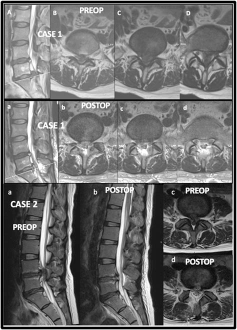 Technical Feasibility Of Combined Uniportal Unilateral Laminotomy With