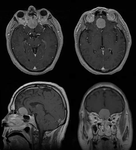 Right Pterional Craniotomy For Olfactory Groove Meningioma