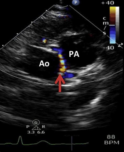 Parasternal Short Axis View With Color Flow Doppler Showing A Vessel Download Scientific